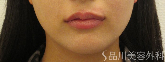 症例NO.72714のAFTER写真