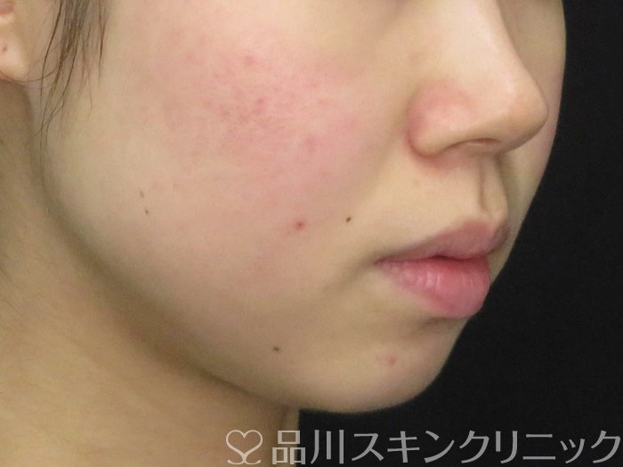 症例NO.65475のBEFORE写真