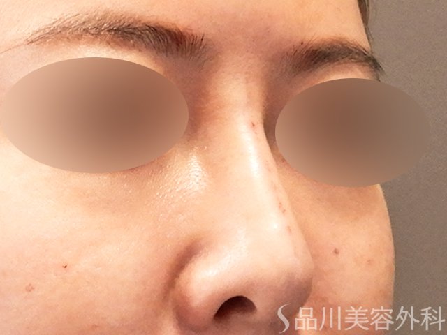 症例NO.69627のAFTER写真