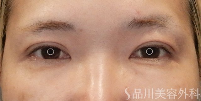 症例NO.75109のAFTER写真