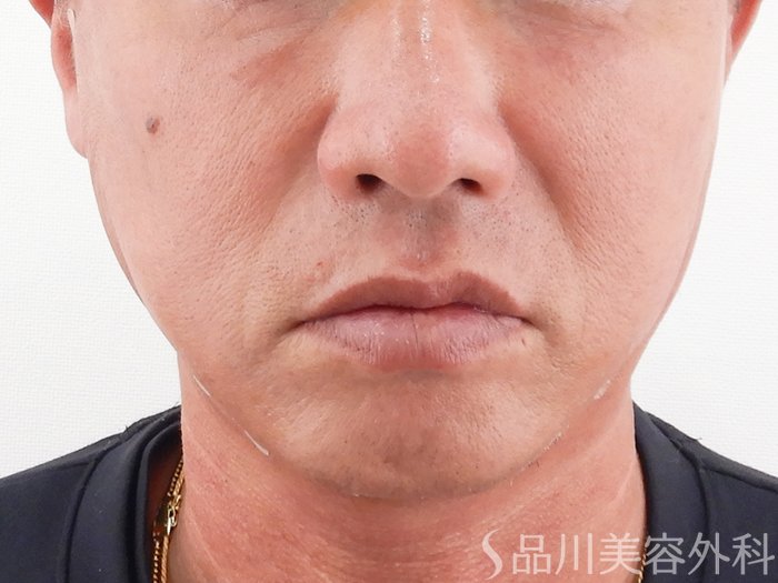 症例NO.62191のAFTER写真