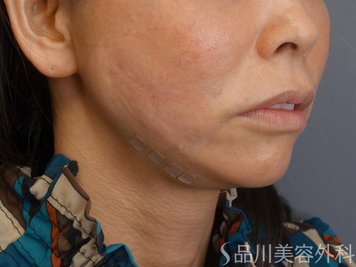 症例NO.72631のAFTER写真