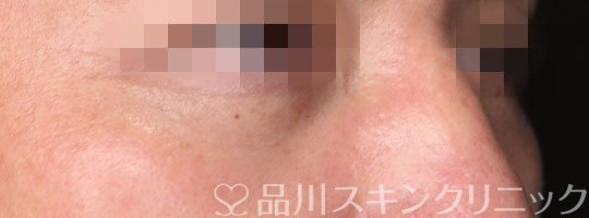 症例NO.70556のAFTER写真