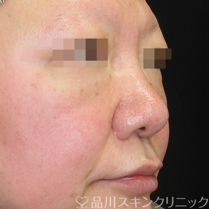 症例NO.73240のBEFORE写真