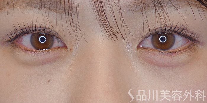 症例NO.72070のAFTER写真