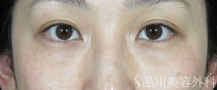 症例NO.62179のBEFORE写真