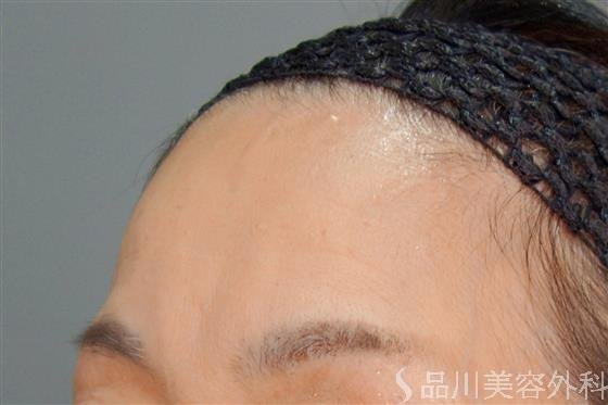 症例NO.54866のBEFORE写真