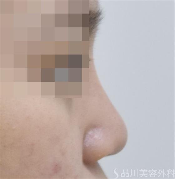 症例NO.46180のAFTER写真
