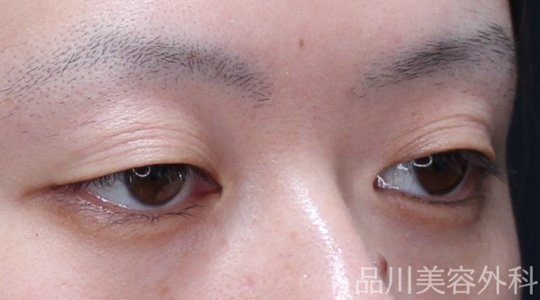 症例NO.74876のBEFORE写真