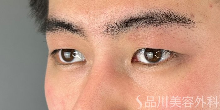症例NO.69284のBEFORE写真