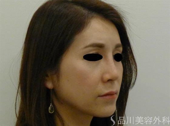 症例NO.43756のAFTER写真