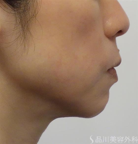 症例NO.50046のAFTER写真