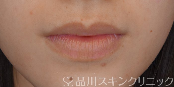 症例NO.72207のBEFORE写真