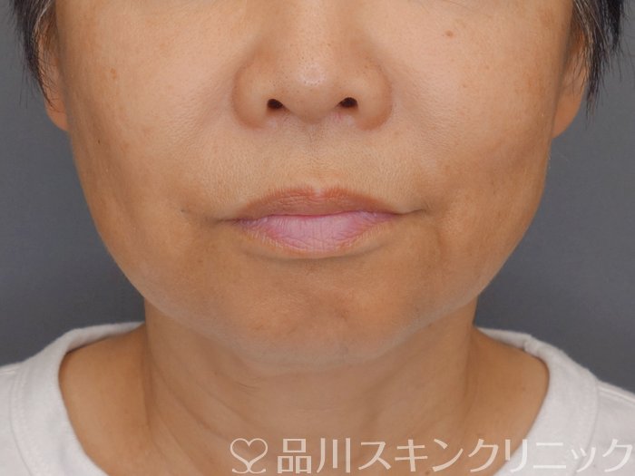 症例NO.71336のBEFORE写真
