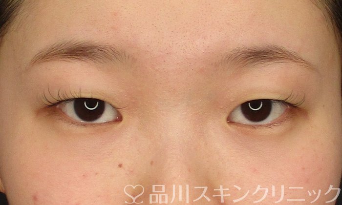 症例NO.69700のBEFORE写真