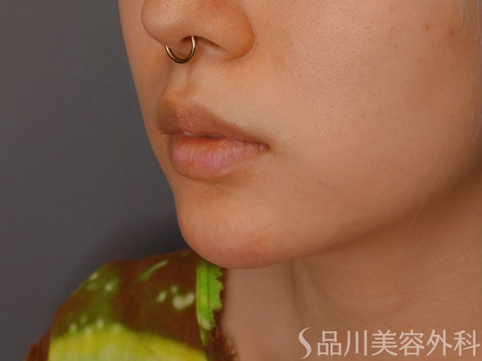 症例NO.70191のAFTER写真