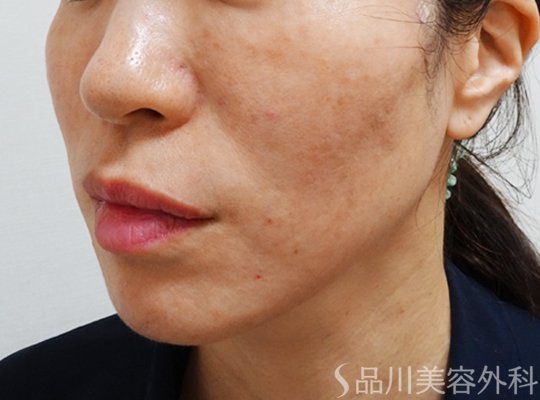 症例NO.73120のAFTER写真