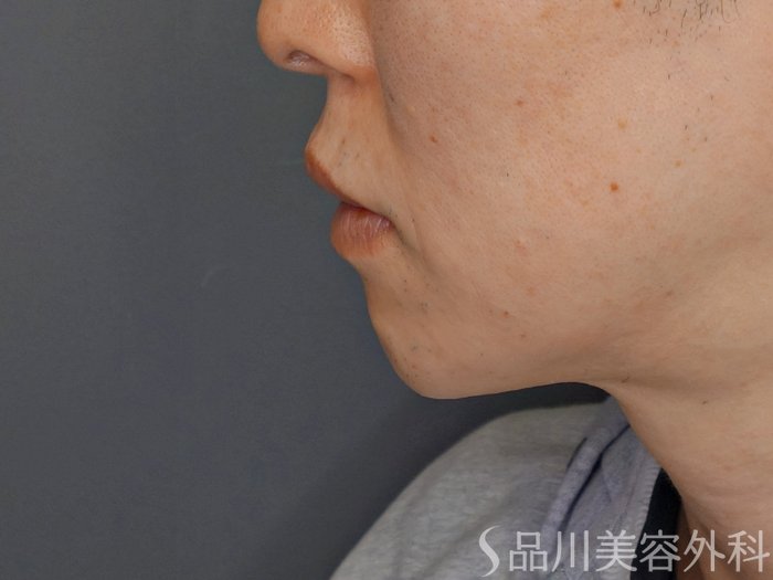 症例NO.72866のBEFORE写真