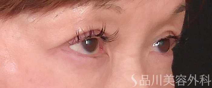 症例NO.70223のAFTER写真