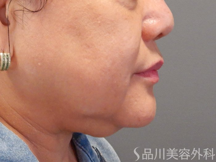 症例NO.71382のBEFORE写真