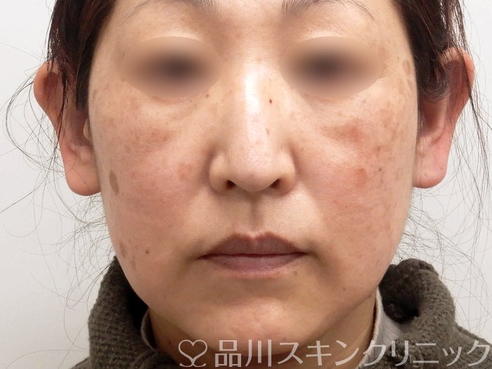 症例NO.62471のBEFORE写真
