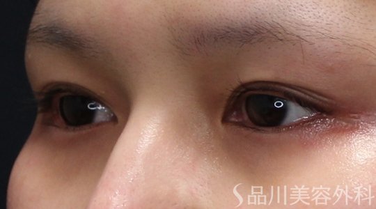 症例NO.75188のBEFORE写真