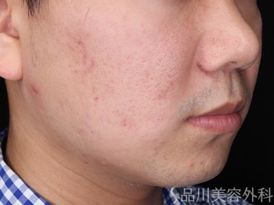 症例NO.70325のBEFORE写真