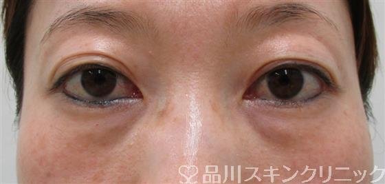症例NO.52759のBEFORE写真