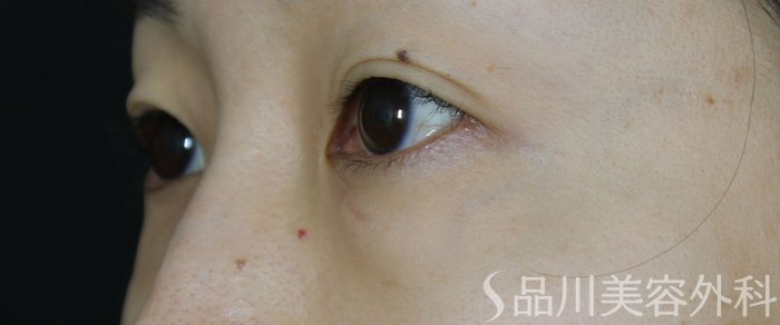 症例NO.69753のBEFORE写真