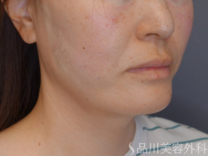 症例NO.72110のAFTER写真