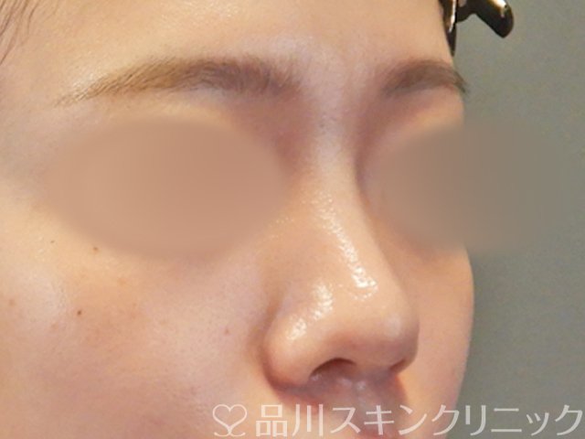 症例NO.65617のBEFORE写真
