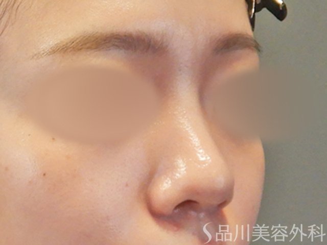 症例NO.65617のBEFORE写真