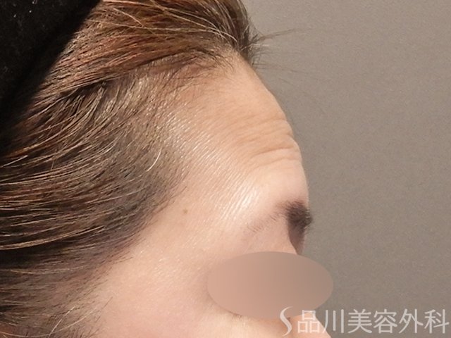 症例NO.72800のBEFORE写真