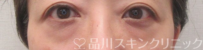 症例NO.71049のBEFORE写真