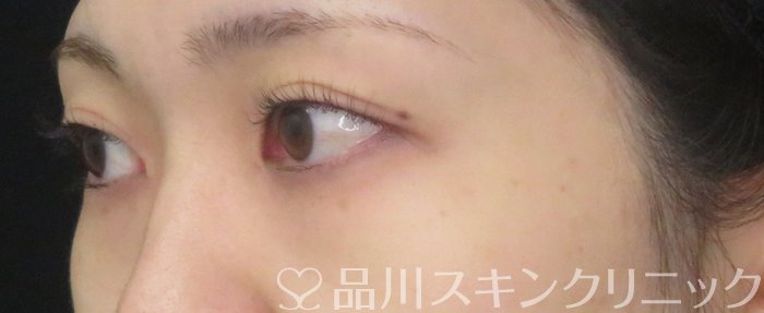 症例NO.74939のBEFORE写真