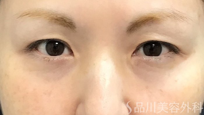 症例NO.69478のBEFORE写真