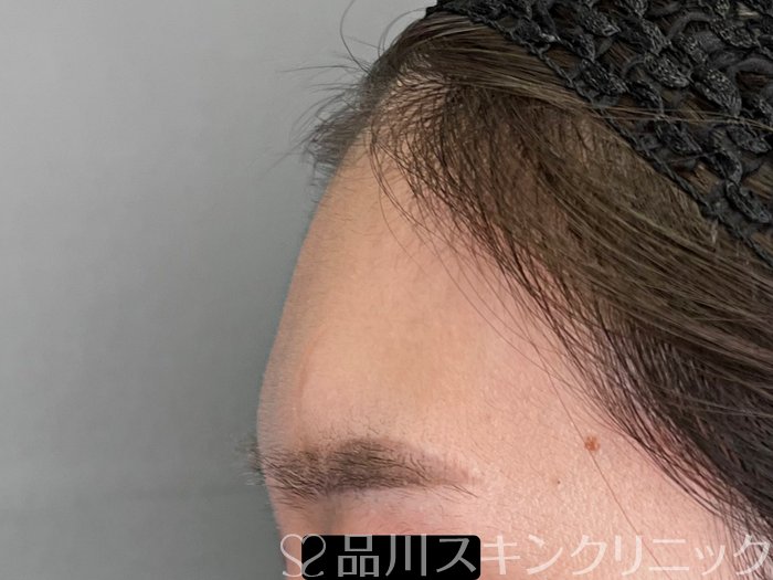 症例NO.69717のBEFORE写真