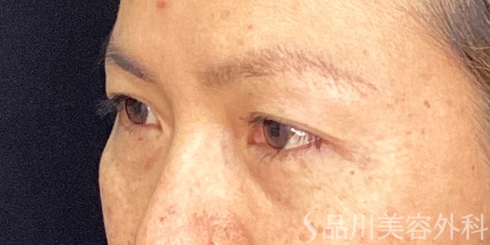 症例NO.73041のBEFORE写真