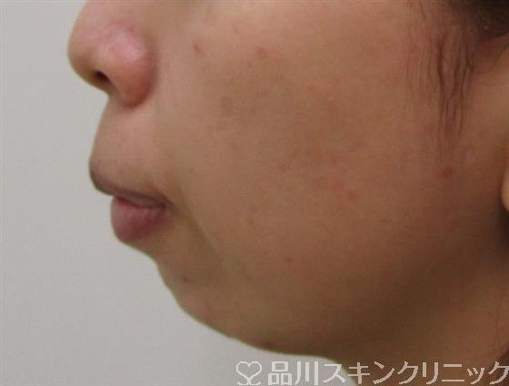 症例NO.39635のBEFORE写真