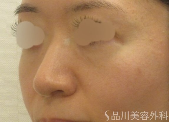 症例NO.72267のBEFORE写真