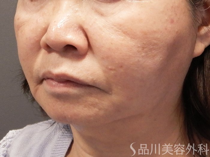 症例NO.72163のAFTER写真