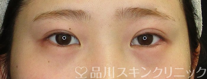 症例NO.74045のAFTER写真