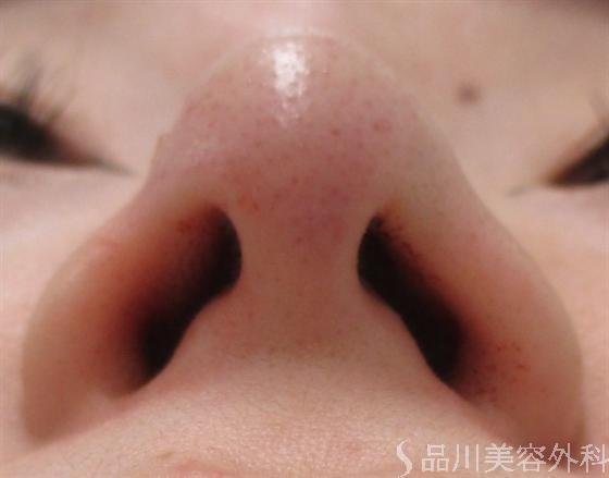 症例NO.14485のAFTER写真