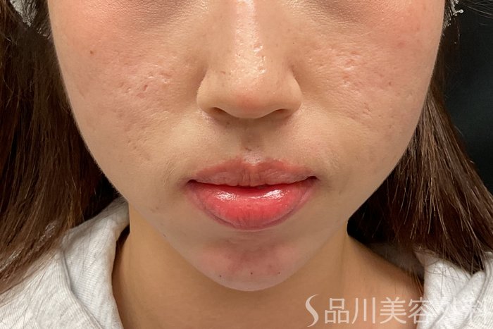 症例NO.73323のAFTER写真