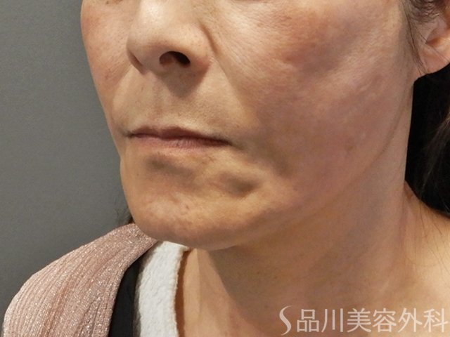 症例NO.71868のAFTER写真