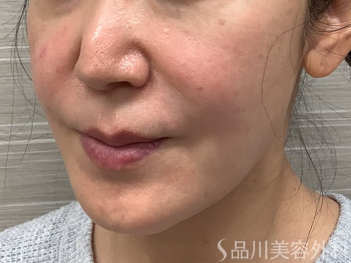 症例NO.62261のBEFORE写真