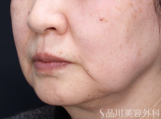 症例NO.73764のBEFORE写真