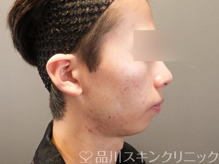 症例NO.68375のAFTER写真