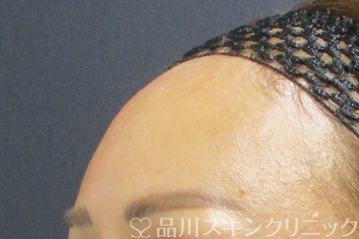 症例NO.70124のAFTER写真