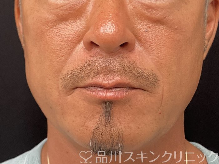 症例NO.73959のAFTER写真